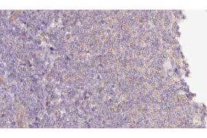 ABIN6273058 at 1/100 staining Human lymph cancer tissue by IHC-P. (MTO1 Antikörper  (N-Term))