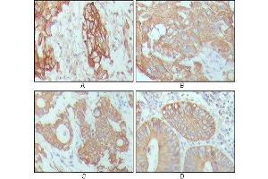 Immunohistochemical analysis of paraffin-embedded human breast carcinoma (A), hepatocarcinoma (B), stomach cancer (C) and colon cancer tissue (D), showing cytoplasmic location with DAB staining using CK18 mouse mAb. (Cytokeratin 18 Antikörper  (AA 391-483))