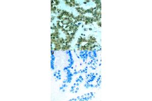 Immunohistochemical staining of human lung cancer tissue by PRKCQ (phospho S676) polyclonal antibody  without blocking peptide (A) or preincubated with blocking peptide (B) under 1:50-1:100 dilution. (PKC theta Antikörper  (pSer676))