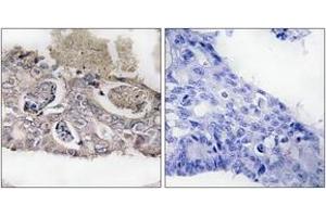 Immunohistochemistry analysis of paraffin-embedded human colon carcinoma tissue, using MARK2 (Ab-596) Antibody. (MARK2 Antikörper  (AA 562-611))