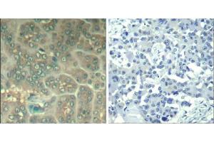 Immunohistochemical analysis of paraffin-embedded human lung carcinoma tissue using chk2 (Ab-33) Antibody (E021527). (CHEK2 Antikörper)