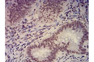 Immunohistochemical analysis of paraffin-embedded rectum cancer tissues using EHMT2 mouse mAb with DAB staining. (EHMT2 Antikörper  (AA 317-471))