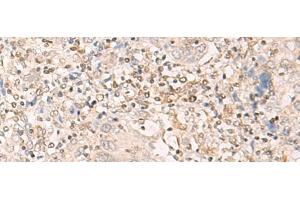 Immunohistochemistry of paraffin-embedded Human cervical cancer tissue using EPSTI1 Polyclonal Antibody at dilution of 1:25(x200) (EPSTI1 Antikörper)