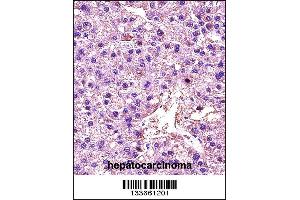 LDHA Antibody immunohistochemistry analysis in formalin fixed and paraffin embedded human hepatocarcinoma followed by peroxidase conjugation of the secondary antibody and DAB staining. (Lactate Dehydrogenase A Antikörper  (C-Term))