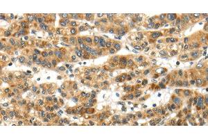 Immunohistochemistry of paraffin-embedded Human ovarian cancer tissue using PAPPA Polyclonal Antibody at dilution of 1:50 (PAPPA Antikörper)