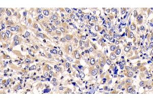 Detection of CTSK in Human Liver cancer Tissue using Polyclonal Antibody to Cathepsin K (CTSK) (Cathepsin K Antikörper  (AA 71-319))