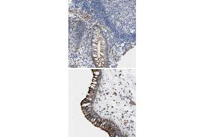 Immunohistochemical staining of human nasopharynx with TWISTNB polyclonal antibody  shows strong cytoplasmic and membranous positivity in respiratory epithelial cells at 1:200-1:500 dilution. (TWIST Neighbor Antikörper)
