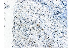 Phospho-EZH2 (Thr345) Antibody at 1/100 staining Human pancreatic cancer by IHC-P.