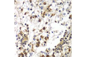 Immunohistochemistry of paraffin-embedded human kidney cancer using SND1 antibody at dilution of 1:100 (40x lens).