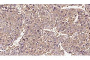 ABIN6279265 at 1/100 staining Human liver cancer tissue by IHC-P. (CATSPER4 Antikörper  (Internal Region))