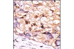 Formalin-fixed and paraffin-embedded human cancer tissue reacted with the primary antibody, which was peroxidase-conjugated to the secondary antibody, followed by DAB staining. (CTDSP1 Antikörper  (C-Term))