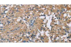 Immunohistochemistry of paraffin-embedded Human thyroid cancer using CAB39L Polyclonal Antibody at dilution of 1:40 (CAB39L Antikörper)