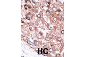 Formalin-fixed and paraffin-embedded human hepatocellular carcinoma tissue reacted with the BAK1 polyclonal antibody  , which was peroxidase-conjugated to the secondary antibody, followed by AEC staining. (BAK1 Antikörper  (N-Term))