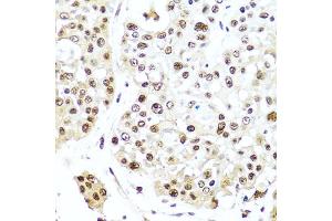 Immunohistochemistry of paraffin-embedded human colon carcinoma using TET2 antibody (ABIN5973320) at dilution of 1/100 (40x lens). (TET2 Antikörper)