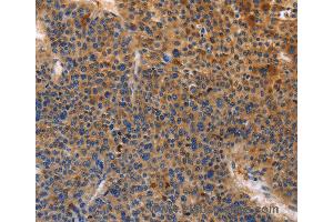 Immunohistochemistry of Human cervical cancer using MUSK Polyclonal Antibody at dilution of 1:30 (MUSK Antikörper)