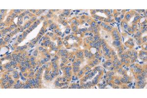 Immunohistochemistry of paraffin-embedded Human thyroid cancer tissue using CARD17 Polyclonal Antibody at dilution 1:50 (CARD17 Antikörper)