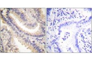 Immunohistochemistry analysis of paraffin-embedded human lung carcinoma tissue, using TIMP4 Antibody. (TIMP4 Antikörper  (AA 175-224))