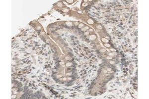 ABIN6267631 at 1/200 staining human colon cancer tissue sections by IHC-P. (PRKAA1 Antikörper  (pSer486))