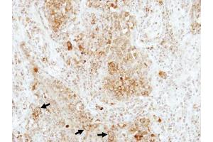 IHC-P Image Immunohistochemical analysis of paraffin-embedded human lung adenocarcinoma, using RAP1B, antibody at 1:100 dilution.