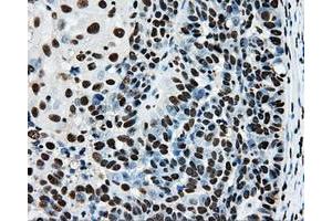 Immunohistochemical staining of paraffin-embedded Adenocarcinoma of breast tissue using anti-RPA2 mouse monoclonal antibody. (RPA2 Antikörper)