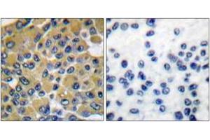 Immunohistochemistry analysis of paraffin-embedded human breast carcinoma tissue, using SHP-2 (Ab-542) Antibody.