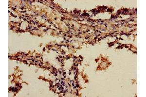 Immunohistochemistry of paraffin-embedded human lung cancer using ABIN7143652 at dilution of 1:100 (ADH7 Antikörper  (AA 1-386))