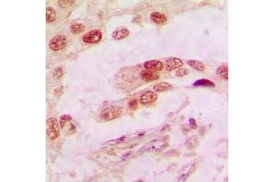 Immunohistochemical analysis of Annexin A1 staining in human lung cancer formalin fixed paraffin embedded tissue section.