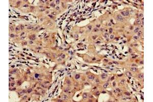 Immunohistochemistry of paraffin-embedded human lung cancer using ABIN7175463 at dilution of 1:100 (VTI1A Antikörper  (AA 1-175))