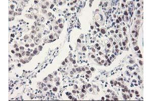 Immunohistochemical staining of paraffin-embedded Carcinoma of Human lung tissue using anti-RBBP7 mouse monoclonal antibody. (RBBP7 Antikörper)