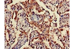 Immunohistochemistry of paraffin-embedded human lung cancer using ABIN7166452 at dilution of 1:100 (TPST1 Antikörper  (AA 283-370))
