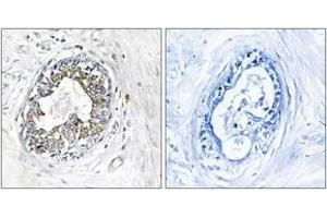 Immunohistochemistry analysis of paraffin-embedded human breast carcinoma tissue, using PAK1/2 (Ab-199) Antibody. (PAK1/2 Antikörper  (AA 165-214))