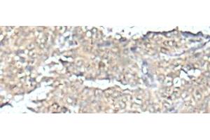 Immunohistochemistry of paraffin-embedded Human ovarian cancer tissue using MEF2D Polyclonal Antibody at dilution of 1:50(x200) (MEF2D Antikörper)