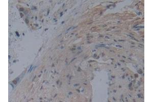 Detection of NOG in Human Pancreatic cancer Tissue using Monoclonal Antibody to Noggin (NOG) (NOG Antikörper  (AA 28-232))