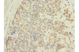 Immunohistochemistry of paraffin-embedded human gastric cancer using ABIN7143116 at dilution of 1:100 (ACTRT1 Antikörper  (AA 201-376))