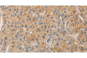 Immunohistochemistry of paraffin-embedded Human liver cancer using NFE2L1 Polyclonal Antibody at dilution of 1:30 (NFE2L1 Antikörper)