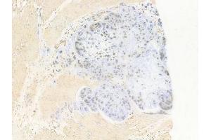 ABIN6264373 and ABIN6277684 at 1/100 staining human gastric carcinoma by IHC-P. (PPARD Antikörper  (C-Term))