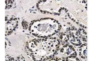 ABIN7097182 and ABIN7101250 at 1/100 staining human ovarian cancer by IHC-P. (FAM122B Antikörper)