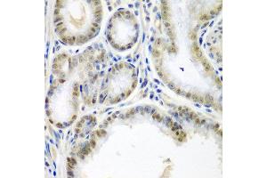 Immunohistochemistry of paraffin-embedded human colon carcinoma using SSX2 antibody at dilution of 1:200 (40x lens). (SSX2 Antikörper)
