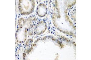 Immunohistochemistry of paraffin-embedded human colon carcinoma using SSX2 antibody at dilution of 1:200 (40x lens).