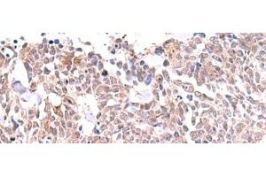 Immunohistochemistry of paraffin-embedded Human lung cancer tissue using INPP5K Polyclonal Antibody at dilution of 1:85(x200)