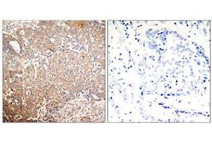 Immunohistochemical analysis of paraffin-embedded human breast carcinoma tissue using Keratin 18 (Phospho-Ser33) antibody (E011306). (Cytokeratin 18 Antikörper  (pSer33))