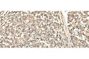 Immunohistochemistry of paraffin-embedded Human esophagus cancer tissue using BUD31 Polyclonal Antibody at dilution of 1:75(x200) (BUD31 Antikörper)