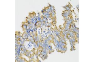 Immunohistochemistry of paraffin-embedded human rectal cancer using GHRL antibody (ABIN6131231, ABIN6141079, ABIN6141080 and ABIN6216264) at dilution of 1:100 (40x lens). (Ghrelin Antikörper  (AA 1-117))