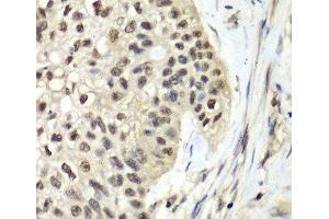 Immunohistochemistry of paraffin-embedded Human lung cancer using RFC5 Polyclonal Antibody at dilution of 1:100 (40x lens). (RFC5 Antikörper)