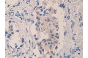 Detection of F5 in Human Breast cancer Tissue using Polyclonal Antibody to Coagulation Factor V (F5) (Coagulation Factor V Antikörper  (AA 1979-2217))