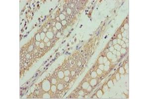Immunohistochemistry of paraffin-embedded human colon cancer using ABIN7169114 at dilution of 1:100 (NEK8 Antikörper  (AA 1-300))