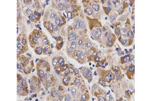 Immunohistochemistry of paraffin-embedded Human liver cancer using UGT1A9 Polyclonal Antibody at dilution of 1:200 (40x lens). (UGT1A9 Antikörper)
