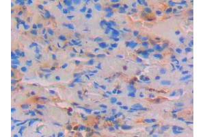 DAB staining on IHC-P; Samples: Human Lung Tissue (STAT4 Antikörper  (AA 505-737))
