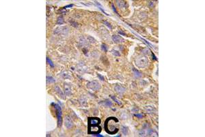 Formalin-fixed and paraffin-embedded human breast carcinoma tissue reacted with EIF4B polyclonal antibody  , which was peroxidase-conjugated to the secondary antibody, followed by DAB staining. (EIF4B Antikörper  (Ser422))