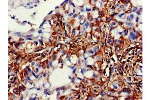 Immunohistochemistry of paraffin-embedded human lung cancer using ABIN7169541 at dilution of 1:100 (ACADSB Antikörper  (AA 34-253))